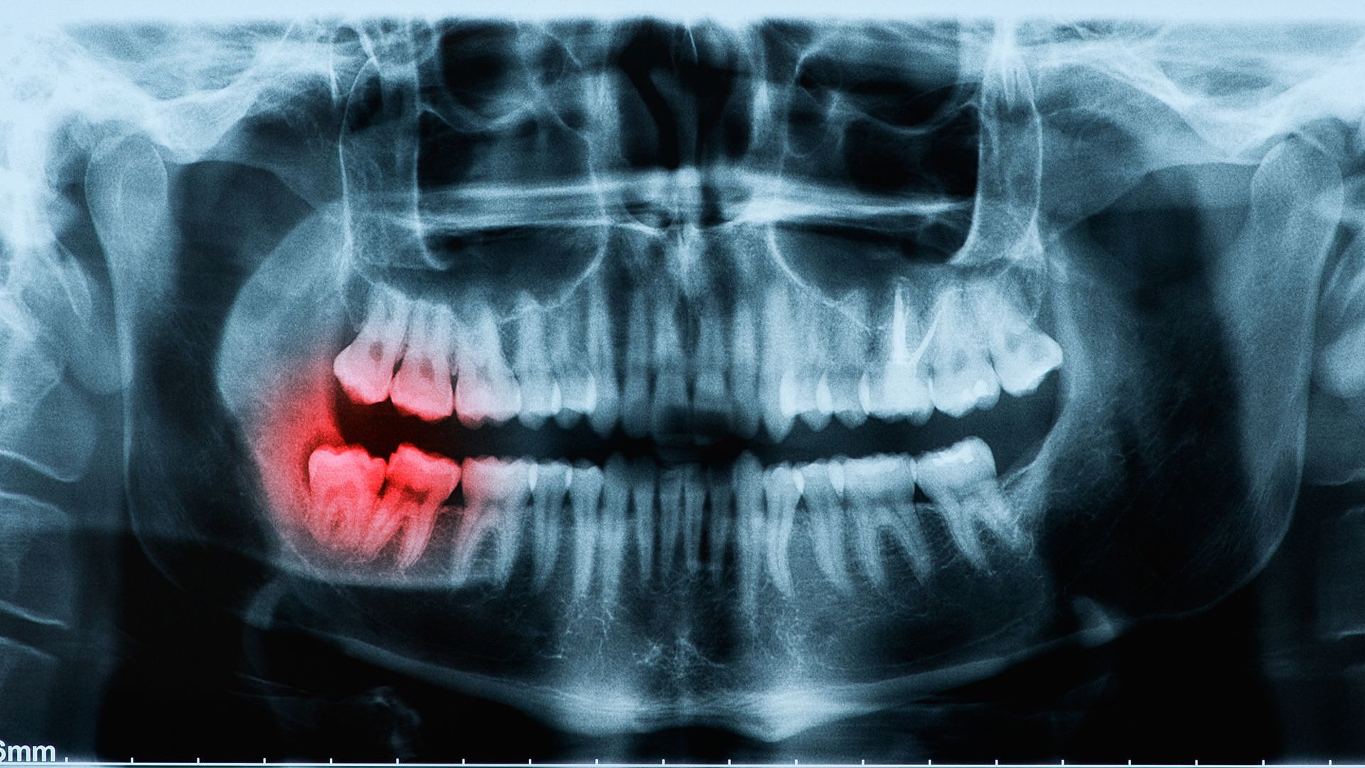 Reversing Bone Loss In Teeth Naturally: A Comprehensive Guide To Prevention And Treatment