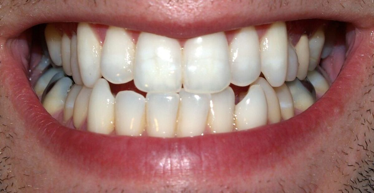 Translucent teeth with enamel loss