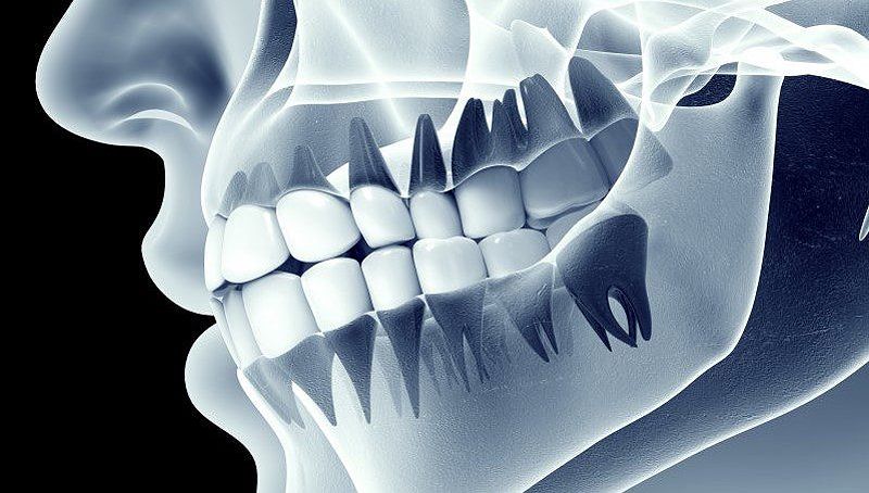 Understanding how we lose jaw bone density